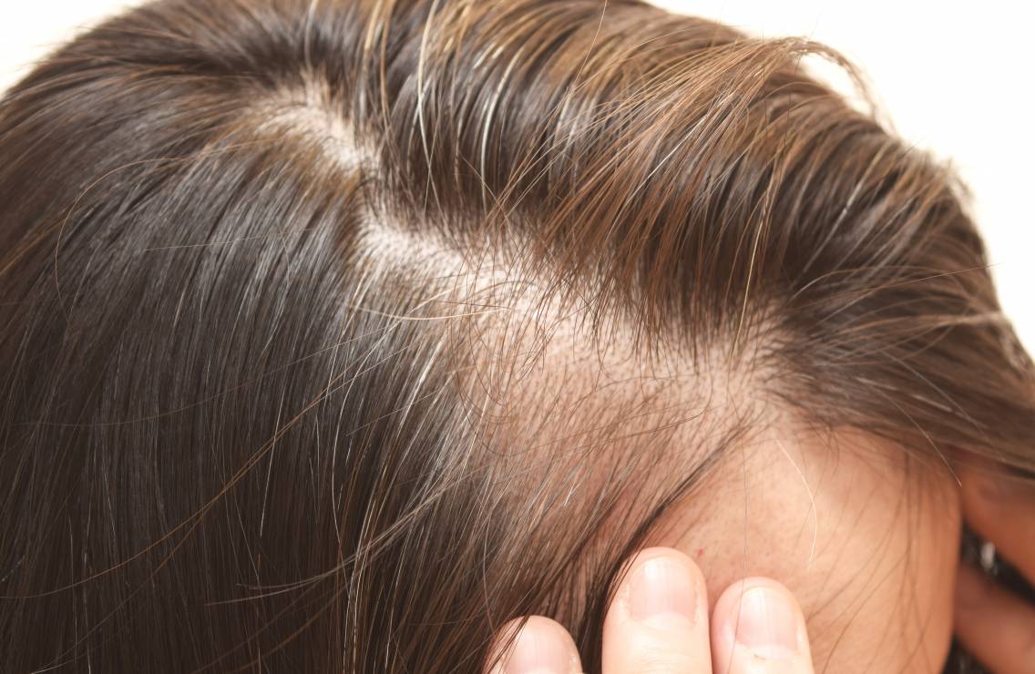 PROMOCJA! Karboksyterapia i mezoterapia igłowa skóry głowy – na ratunek rzadkim i cienkim włosom!